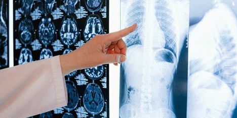 Role of Rare Disease Registry in Treating IPF