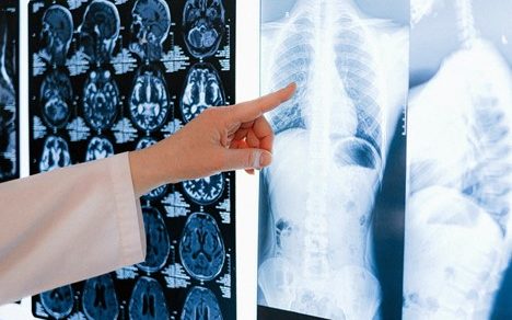 Patient Registry X-ray of Lungs Role of Rare Disease Registry in Treating IPF